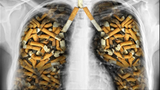 Thuốc lá - Tác nhân hàng đầu gây ung thư phổi, nguy hại đến tính mạng