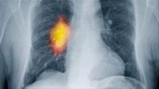 Nguyên nhân bệnh ung thư phổi mà nhiều người không hề biết