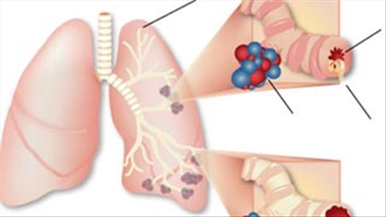 Triệu chứng cận lâm sàng ung thư phổi các bạn cần biết