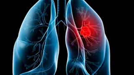 Triệu chứng lâm sàng ung thư phổi - tham khảo đề phòng khi cần