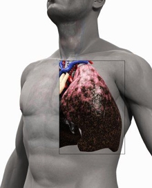 Ung thư phổi - nguyên nhân và các phương pháp phòng bệnh