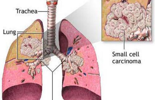 Ung thư phổi: Phải làm gì để chiến thắng bệnh hiểm nghèo?