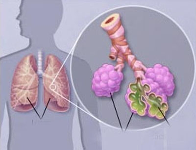Viêm phổi do phế cầu ở trẻ em, phải phòng ngừa thế nào?