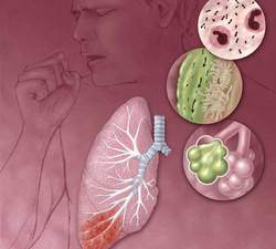 Viêm phổi và những cách phòng ngừa, có thể bạn chưa biết