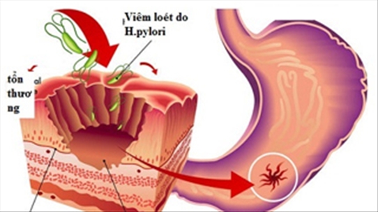 Những lưu ý cực quan trọng khi dùng thuốc diệt H.Pylori ở dạ dày