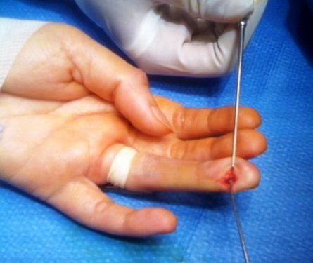 U cuộn mạch búp ngón tay - Tổn thương hiếm gặp nên chú ý