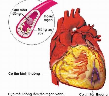 Nguyên nhân gây bệnh mạch vành, có thể bạn chưa biết