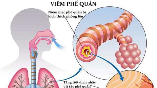 BS Nguyễn Thị Hòa: Hai cách điều trị viêm phế quản cấp - Bạn tham khảo nhé!