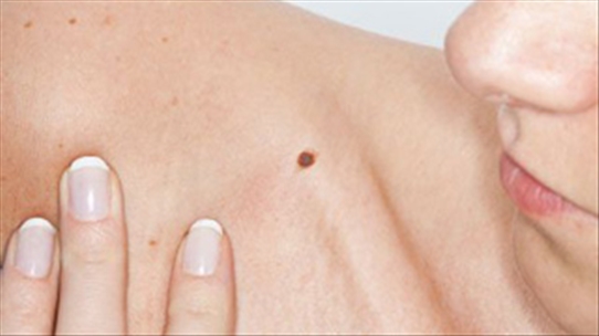 Nốt ruồi trên cơ thể có phải là những khối u hắc tố hay không?