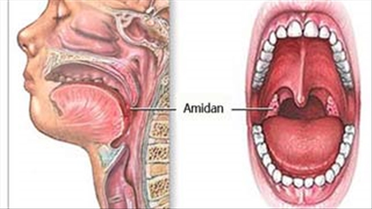 Hướng dẫn cách xác định các giai đoạn bệnh ung thư vòm họng