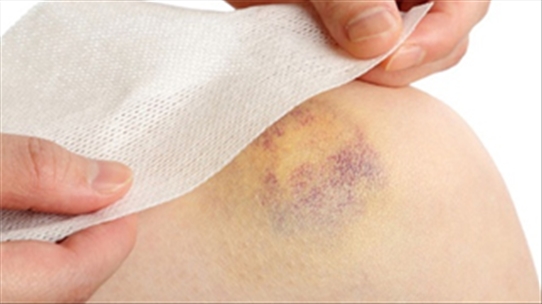 Cảnh giác với những bệnh nguy hiểm về máu khi có vết bầm trên da
