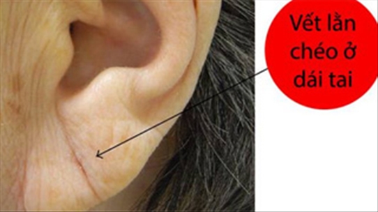 Nếu bạn có vết lằn chéo ở dái tai, nguy cơ cao bị bệnh tim mạch