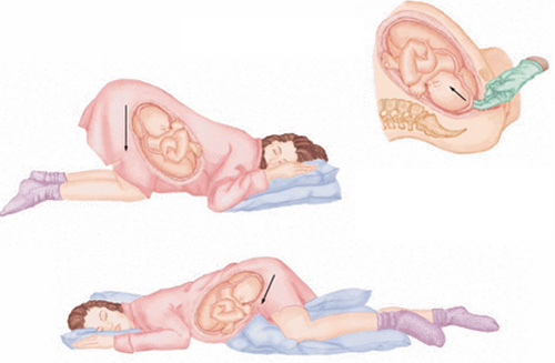 Sa dây rau - Biến chứng nguy hiểm cuối thai kỳ - Các mẹ bầu hãy chú ý nhé!