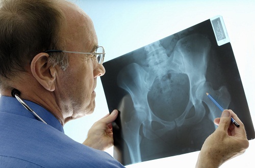 Nguyên nhân do đâu gây ra bệnh đau xương cụt nguy hiểm?