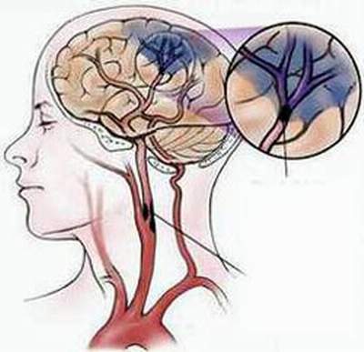 Các phương pháp chăm sóc bệnh nhân bị tai biến mạch máu não