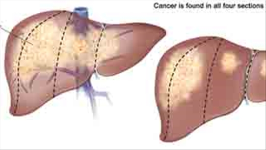 Một số phương pháp có thể điều trị ung thư gan hiện nay