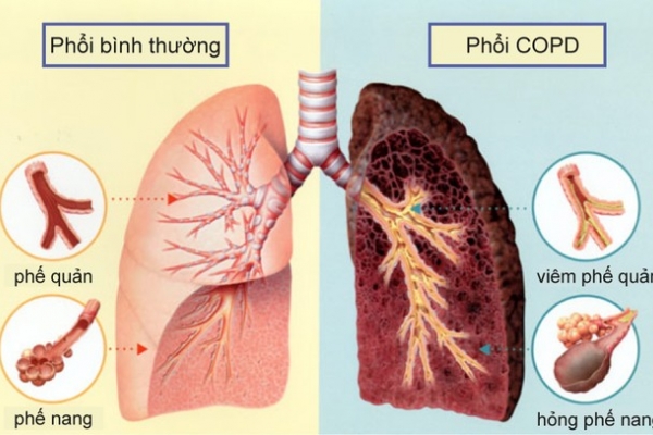 Bật mí cách để bệnh phổi tắc nghẽn mạn tính không trở nặng
