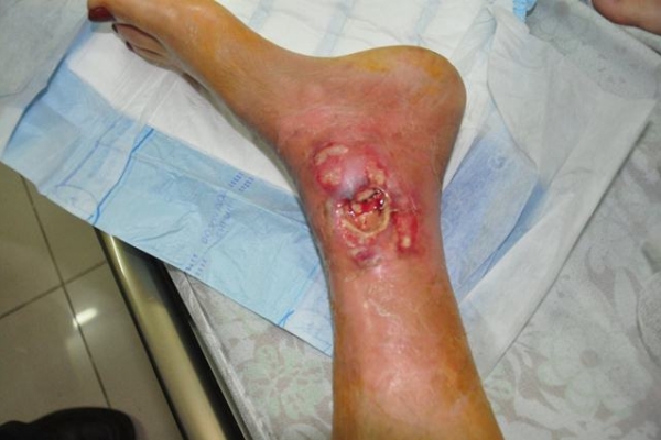 Bệnh nhân đái tháo đường bị cắt cụt chân vì tự ý ngâm nước nóng, lá cây lạ - Bạn nên cẩn trọng