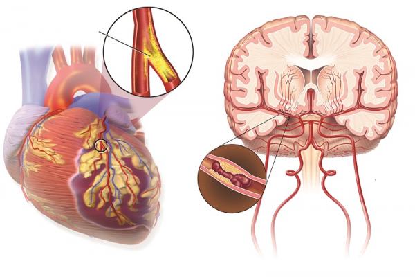 Nghiên cứu khoa học: Phân biệt bản chất của đột quỵ với cơn đau tim