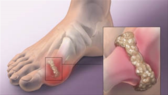 Cơn đau kéo dài nhiều ngày ở các ngón chân là dấu hiệu gút tái phát