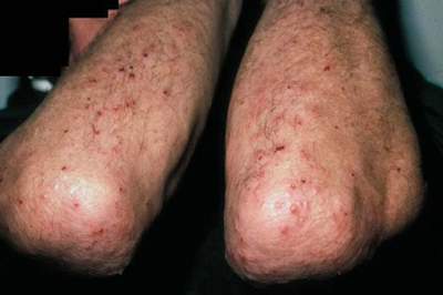 Bệnh viêm da dạng Herpes có mức độ nguy hiểm như thế nào?