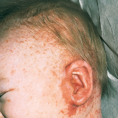 Viêm da tiết bã ở trẻ em - Điều trị như thế nào để không để lại di chứng