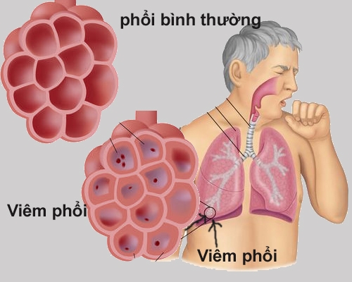 Bất lợi khi dùng thuốc kháng sinh azithromycin, bạn có biết?