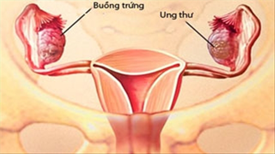 Những phụ nữ dễ bị ung thư buồng trứng - chị em cần phải biết