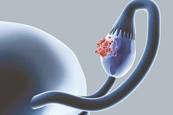 Ung thư buồng trứng: Dễ nhầm lẫn và tỉ lệ tử vong khá cao