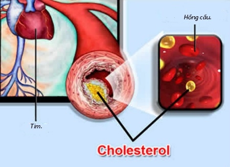 Lạm dụng thuốc điều chỉnh rối loạn lipid máu: Cảnh giác biến cố tim mạch