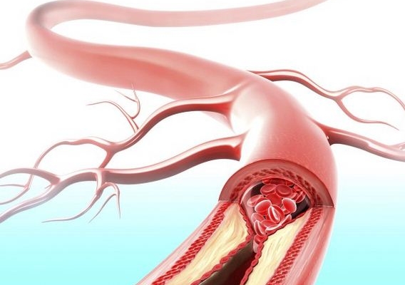 Kiểm soát mỡ máu giúp ngăn chặn biến chứng tim mạch
