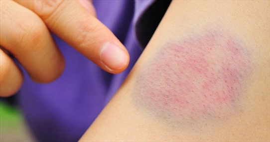 Vết bầm tím trên da: Có thể tự chữa ở nhà nhưng có lúc nên cảnh giác với những bệnh sau