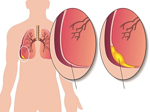 Bạn có biết tràn dịch màng phổi không chỉ đơn thuần bệnh lao