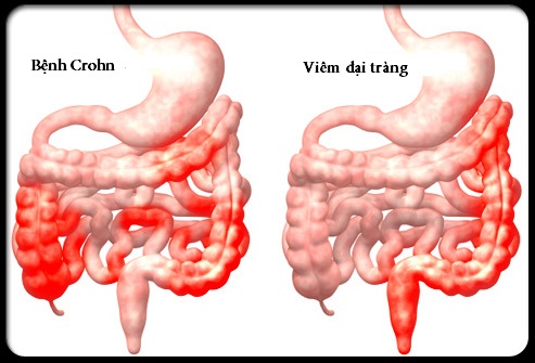 5 cách giảm triệu chứng bệnh Crohn không cần thuốc