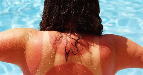 Khi bị cháy nắng, đừng làm những việc này nếu không muốn làn da của bạn bị hư hại thêm