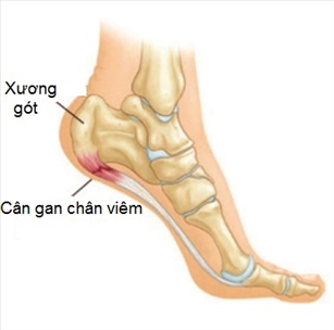 Bạn bị đau vùng gót chân, nguyên nhân gây ra là do đâu?
