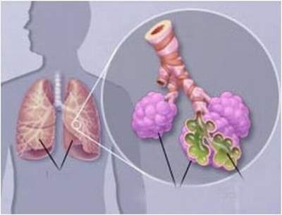 Biểu hiện bệnh viêm phổi do tụ cầu, cách điều trị và phương pháp phòng bệnh