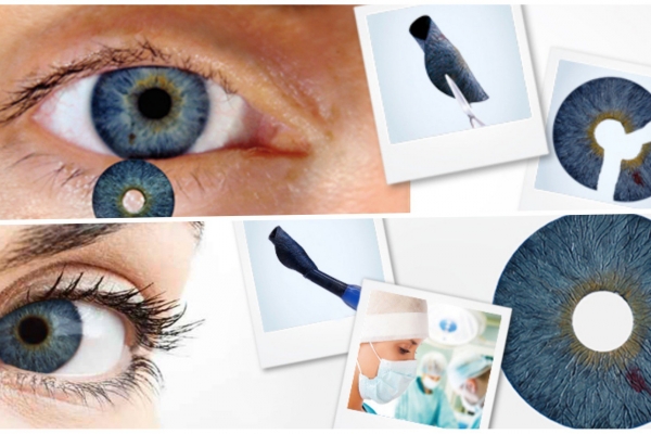 Bạn có biết mống mắt nhân tạo đầu tiên được FDA phê duyệt