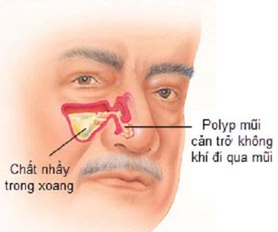 Polyp mũi có nguy hiểm hay không? Làm thế nào để phòng bệnh?