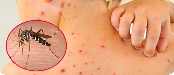 Bộ Y tế đưa 6 khuyến cáo phòng bệnh sốt xuất huyết hiệu quả
