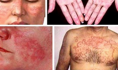Chữa bệnh lupus ban đỏ, cần lưu ý độc tính của thuốc