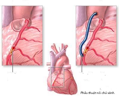 Ai cần phẫu thuật bắc cầu nối động mạch vành bạn có biết