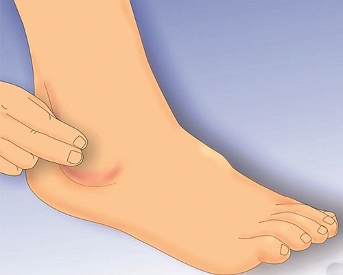 Thoái hóa khớp cổ chân có thể gây biến chứng nguy hiểm