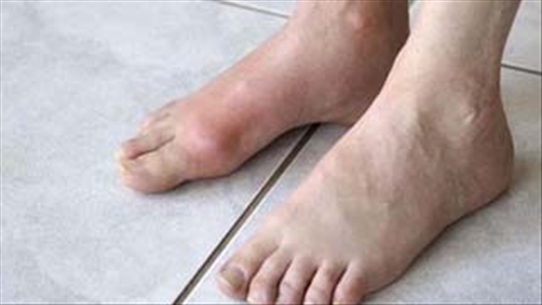 Những lưu ý khi chăm sóc bàn chân cho người bệnh tiểu đường