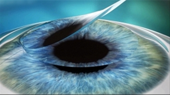 Sau mổ lasik cần chăm sóc mắt thế nào để hồi phục?