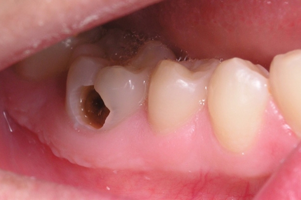 Điểm mặt 9 bệnh về răng miệng nhiều người hay mắc phải