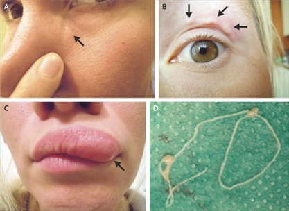 Ký sinh trùng do muỗi truyền làm tổ trên mặt người phụ nữ Nga - Các bạn tham khảo thêm nhé!