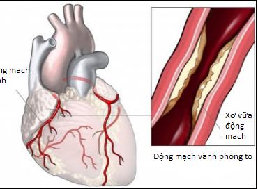 Mách bạn những cách phòng bệnh mạch vành giúp sống khỏe