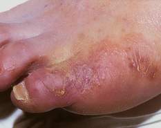 Những bệnh da và niêm mạc do nấm, có thể bạn chưa biết