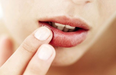 Nẻ môi do thuốc chữa vảy nến, có nên dừng lại không?